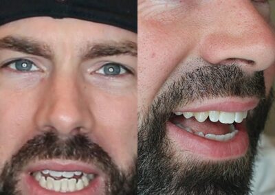 candid pro results matthew d